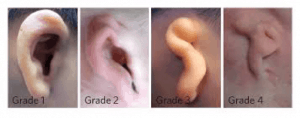 dị dạng vành tai